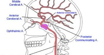 Teach Neurology: Anterior choroidal artery syndrome