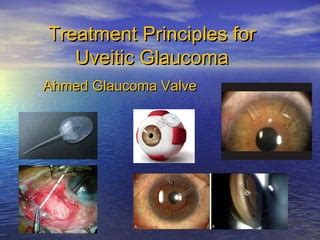 Uveitic Glaucoma | PPT