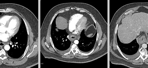 Esophageal Cancer Barretts Esophagus Johns Hopkins Pathology