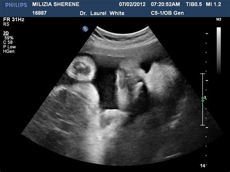 Days Of Our Lives 32 Weeks Ultrasound