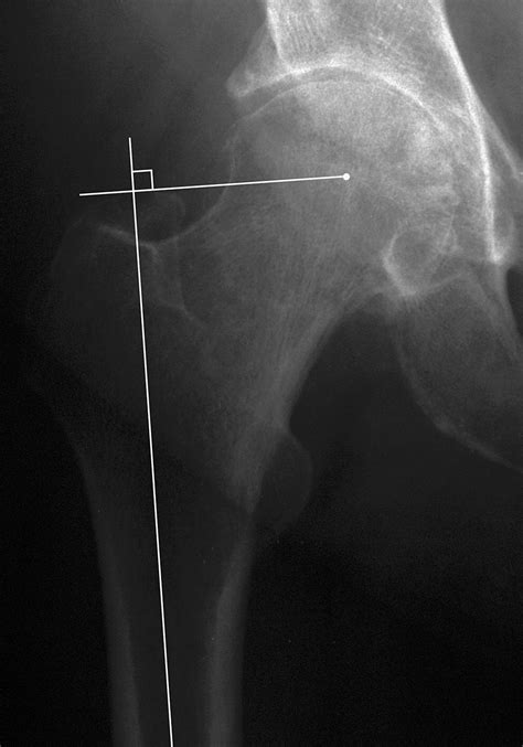 Influence Of Femoral Rotation On Femoral Offset Determined From