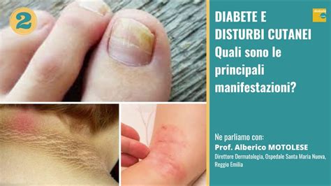 Diabete E Disturbi Cutanei Quali Le Principali Manifestazioni YouTube