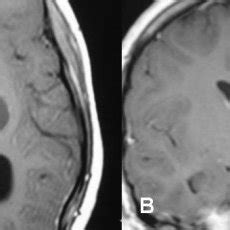 Stereotactic Mri Brain Showed Recurrent Postoperative Brain Stem Cystic