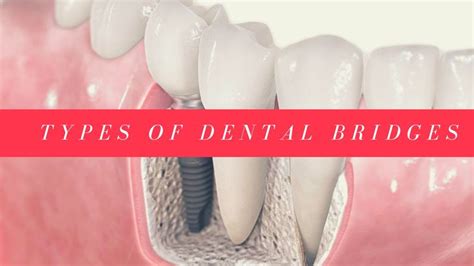 Types Of Dental Bridges :: Torontodentist | Dental bridge, Dental ...