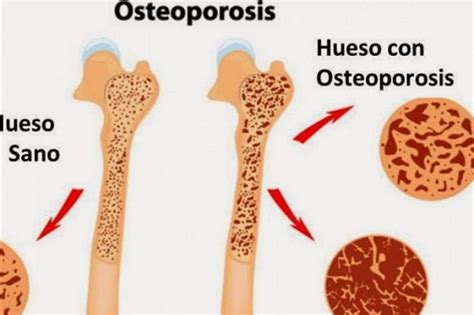 Osteoporosis y ejercicio físico SERGIO PALOMARES LANGA