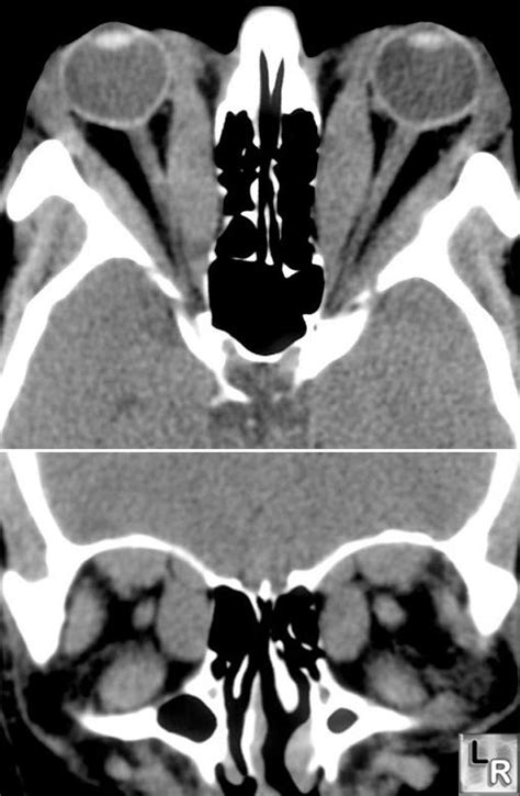 Learning Radiology Thyroid Ophthalmopathy