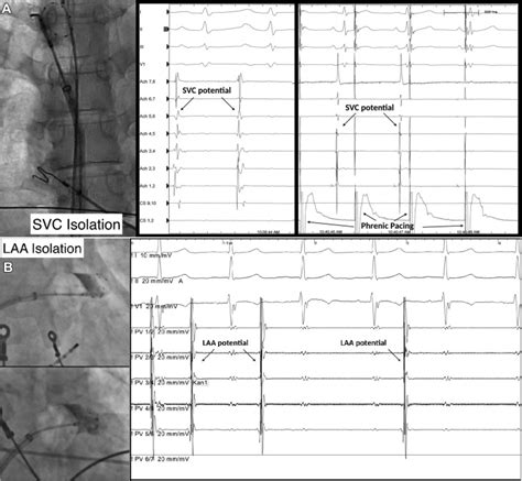 Cryoablation for atrial fibrillation - Heart Rhythm O2