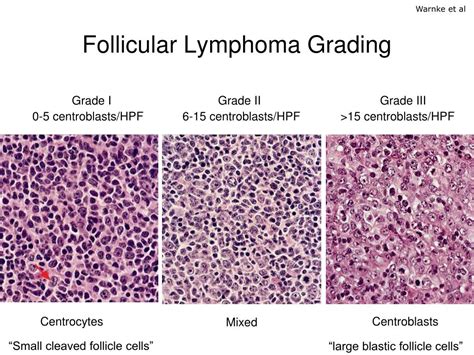 PPT - Follicular Lymphoma PowerPoint Presentation, free download - ID ...