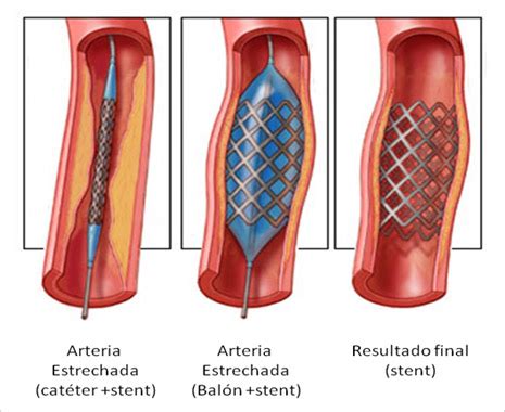 Angioplastia Con Stent La Ciencia Se Enfrenta Al Infarto