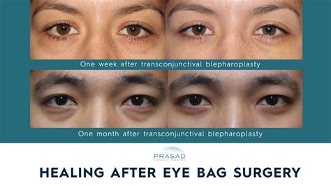 Lower Blepharoplasty Recovery Process | Dr. Prasad Blog