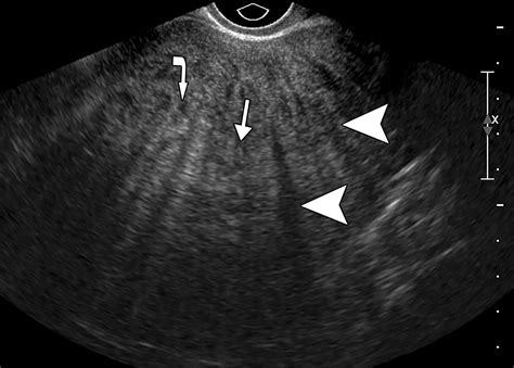 Adenomyosis In Pregnancy Diagnostic Pearls And Pitfalls Radiographics