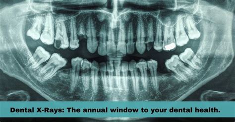 Importance Of Dental X Rays In Dentistry