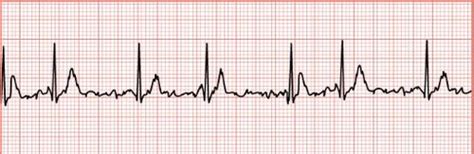 M13b EKG Cardiovascular Testing EKG Strip Readings Artifacts