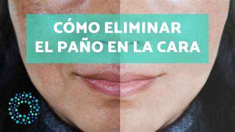 Cómo ELIMINAR el PAÑO en la cara CAUSAS y soluciones para pararlo