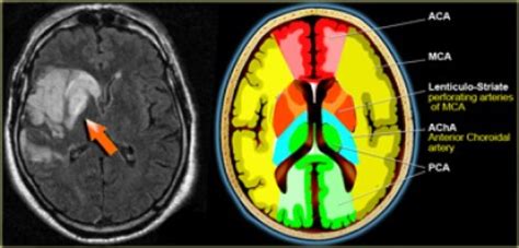 Middle Cerebral Artery Anatomy Radiology Notes