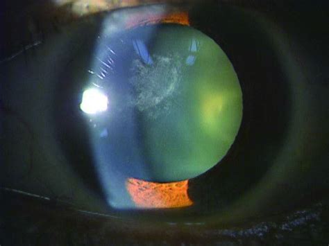 Anterior Capsular Cataract