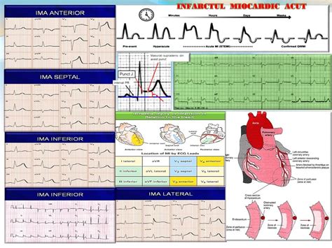 Ppt Infarctul Miocardic Acut Powerpoint Presentation Id 7411495