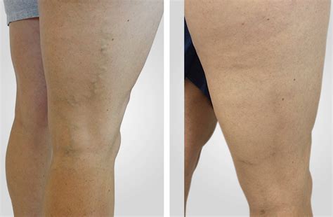 Spider Veins Treatment Spider Vein Laser Removal