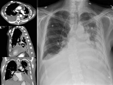 How Does Mesothelioma Differ From Other Lung Cancers