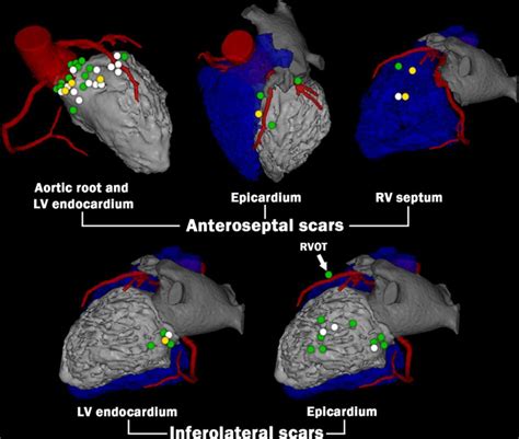 Contrast Enhanced Mriderived Scar Patterns And Associated Ventricular