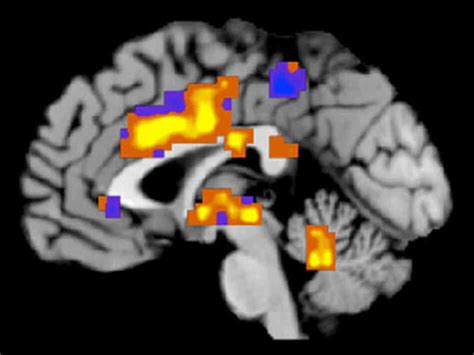 How Much Does It Hurt Lets Scan Your Brain Shots Health News Npr