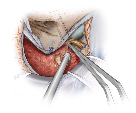 Petroclival Meningioma: Posterior Petrosal Approach | The Neurosurgical ...