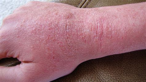 Itching Whats Causing Your Itchy Skin With Pictures