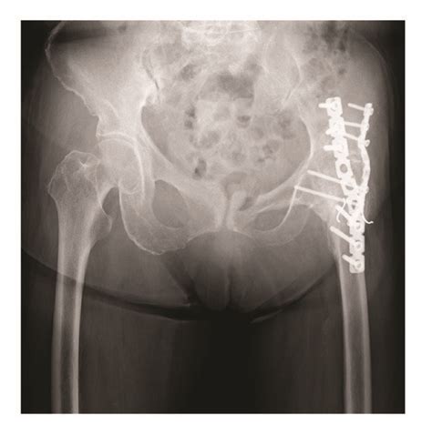 Follow Up Radiographs At 10 Months After Surgery A Ap View And B