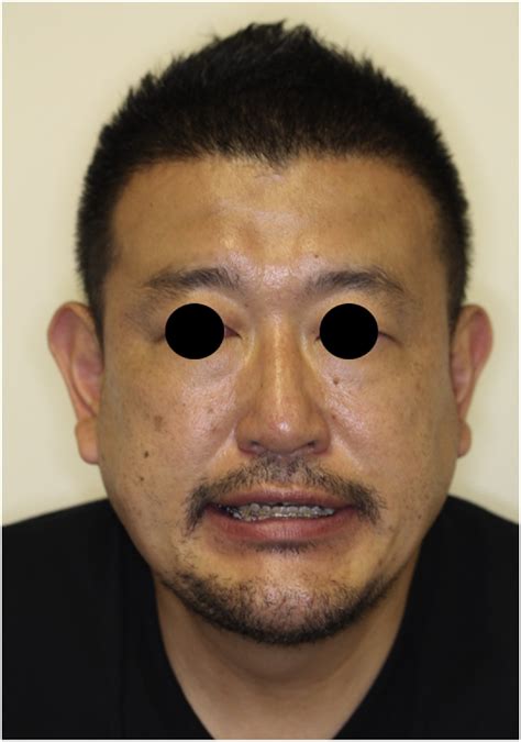 Peripheral Facial Palsy After Bilateral Sagittal Split Ramus Osteotomy Case Report British