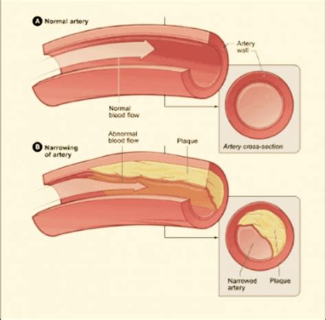 Clinical Aspects Of Angina Pectoris Hubpages