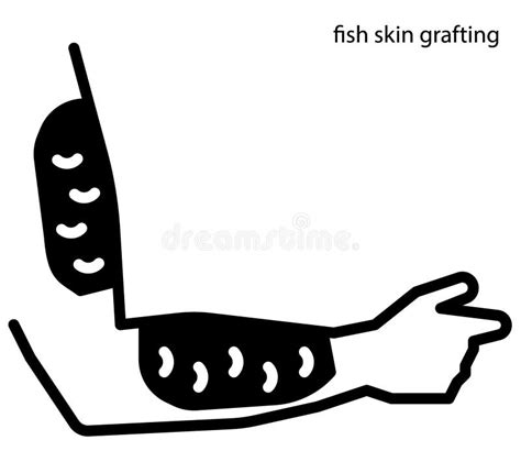 Skin Grafting Stock Illustrations – 35 Skin Grafting Stock ...