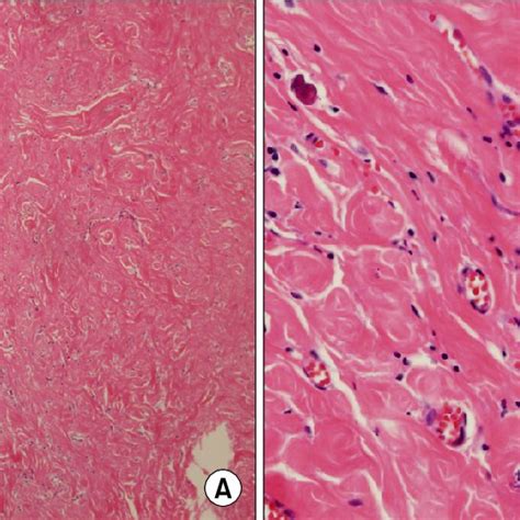 A The Histologic Finding Of The Tumor Shows Hyalinized Collagenous