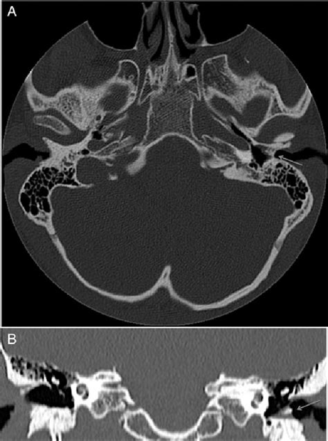 Ct Temporal Bone Axial A And Coronal B Slices Demonstrating A Soft