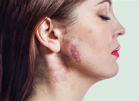 Birthmark Removal Laser Skin Solutions