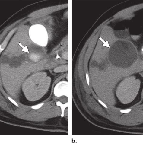 Pdf Biliary Imaging Multimodality Approach To Imaging Of Biliary