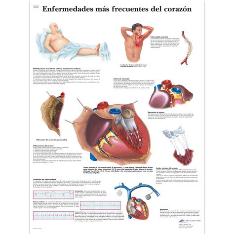 Enfermedades más frecuentes del corazón 1001857 VR3343L