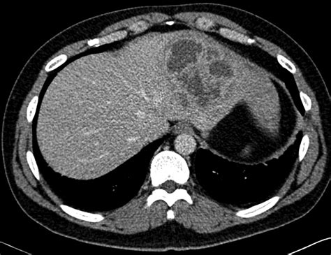 Liver Abscess MRI