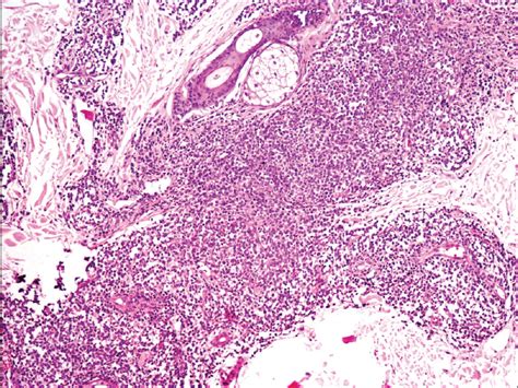 Primary Cutaneous Cd Positive Small Medium T Cell Lymphoma Indian