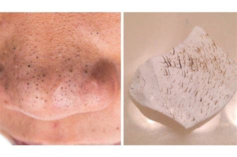 Heres What You Should Know Before Using Pore Strips Shrinkpores