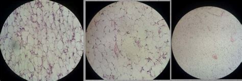 Histopathological Examination Showed Mature Fat Cells And No Cellular