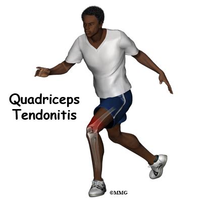 Quadriceps Tendonitis - eOrthopod.com