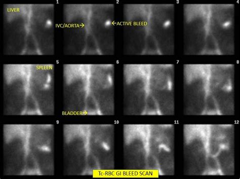 Tc Rbc Gi Bleed Imaging Scan Example Labeled Nuclear Medicine