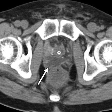 Anastomotic Leak After Robot Assisted Laparoscopic Radical