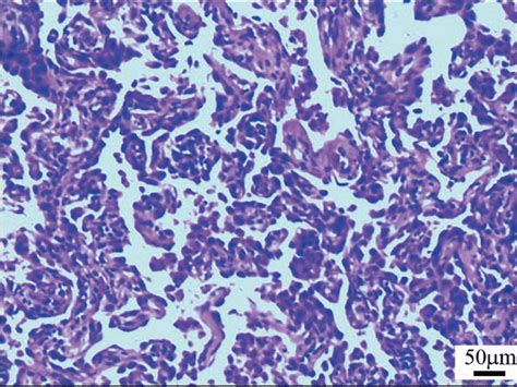 Histopathological Images The Alveolar Epithelium In The Diseased