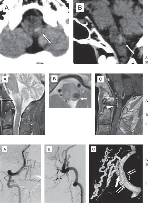 Figure From A Case Of Dural Arteriovenous Fistula At The