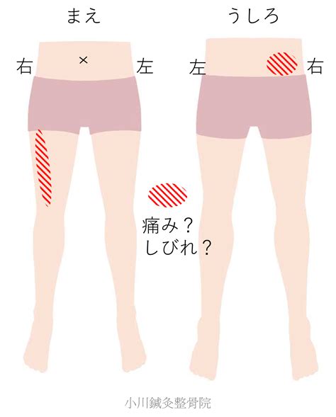 腰・太ももの前の痛みの改善例（中年男性編）【平野区 生野区 南巽 はり 腰痛 小川鍼灸整骨院】 小川鍼灸整骨院