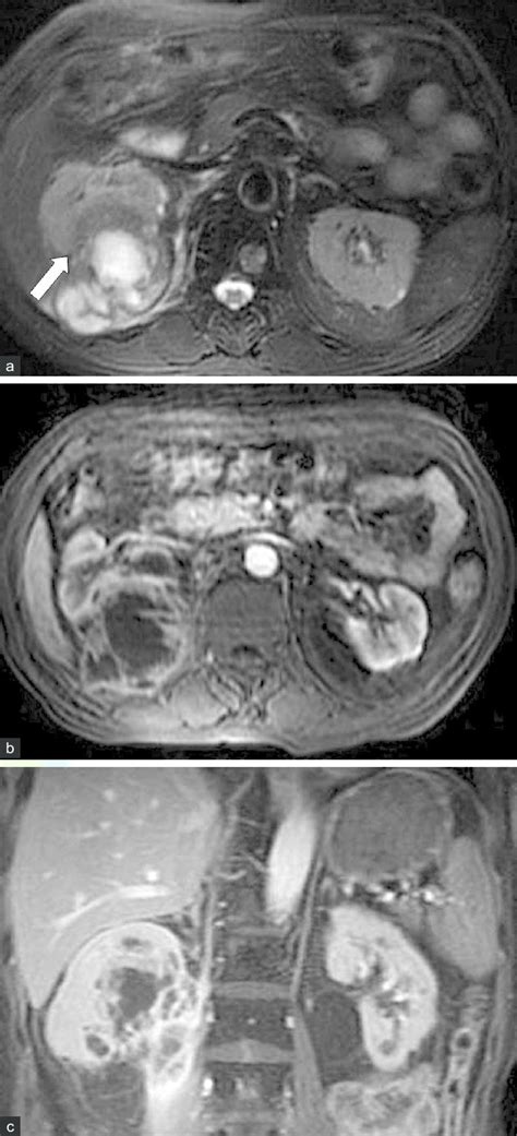 T Hypointense Renal Lesion