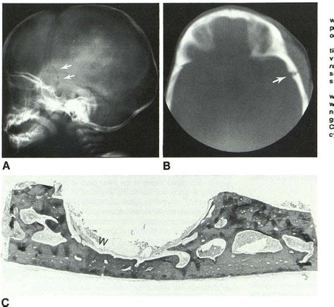 [pdf] Temporoparietal Dermoid Cysts With Intracranial Extension