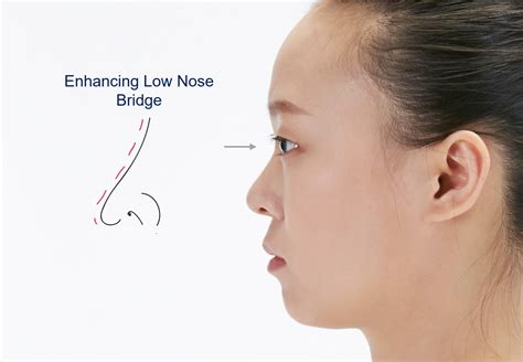 The Ultimate Guide To HIKO Korean Nose Thread Lift In Singapore Dream