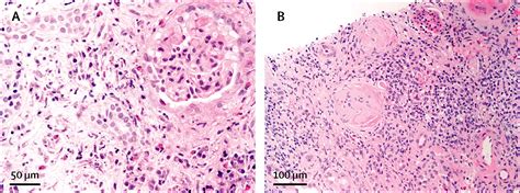 Igg Related Disease The Lancet